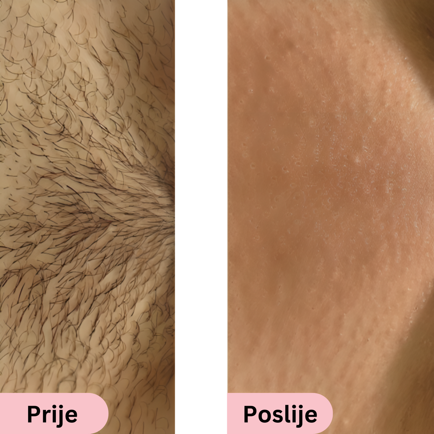 Glowie™ IPL fotoepilator – Uređaj za uklanjanje dlačica